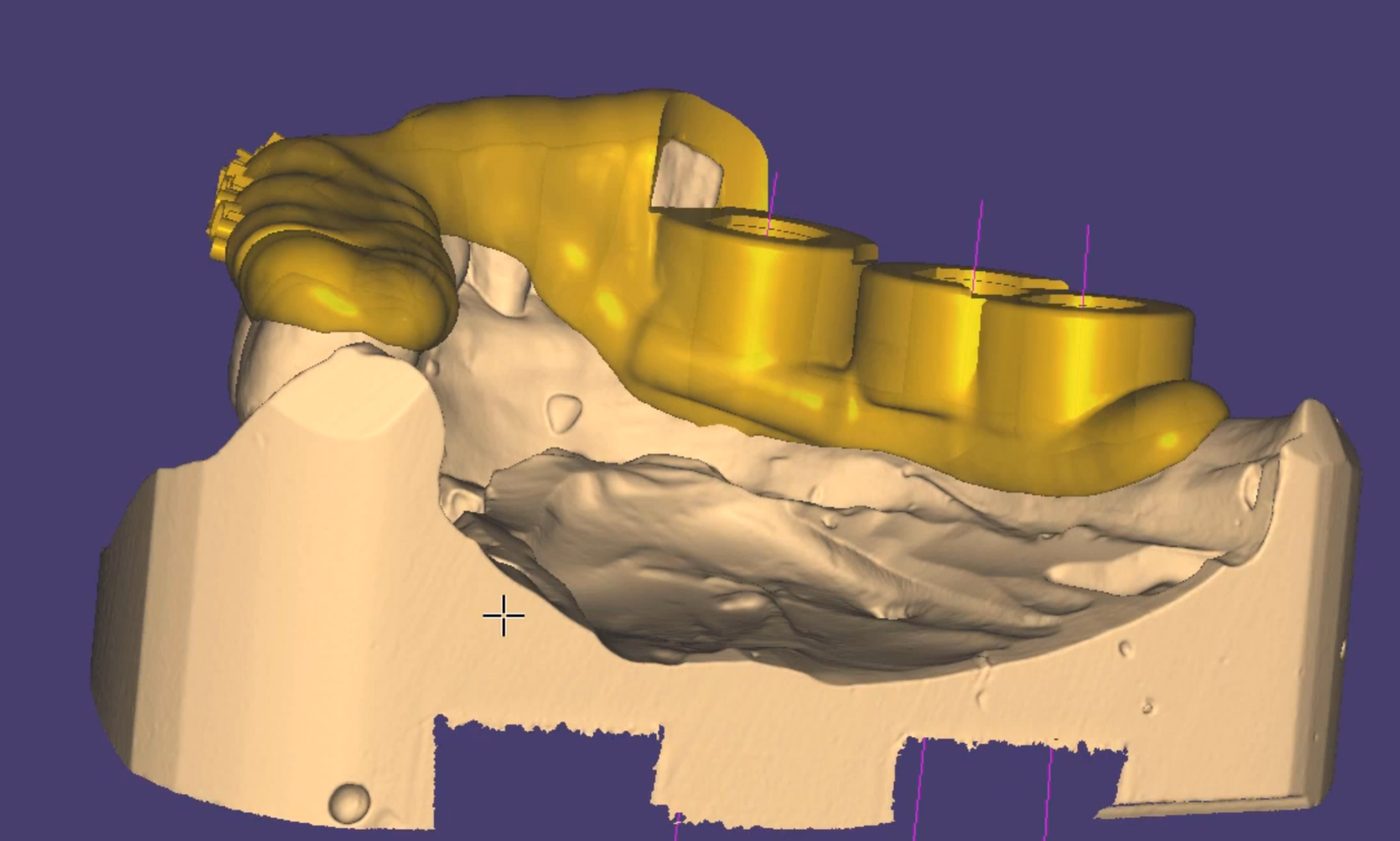 Surgical Guides CAD design – real design case 7