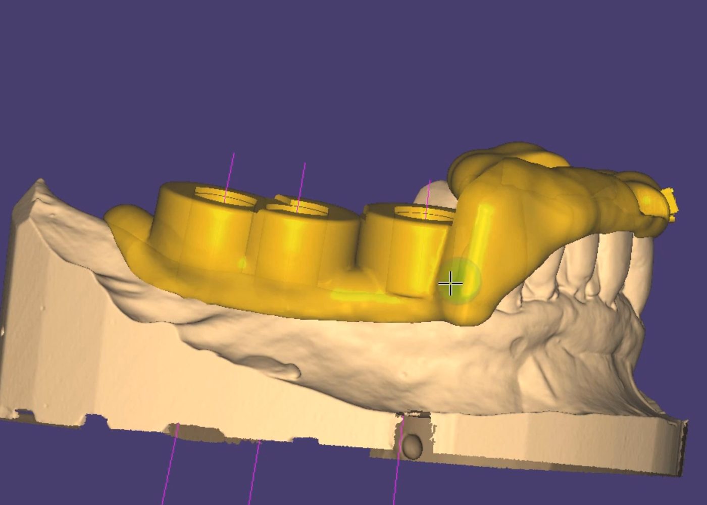 Surgical Guides CAD design – real design case 8