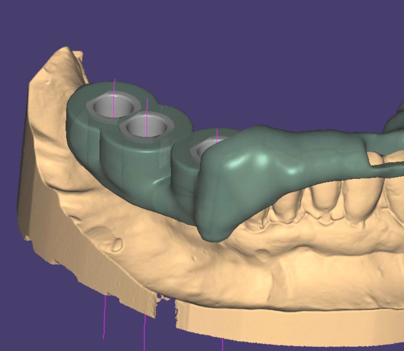 Guide design with sleeves – Surgical Guides CAD design