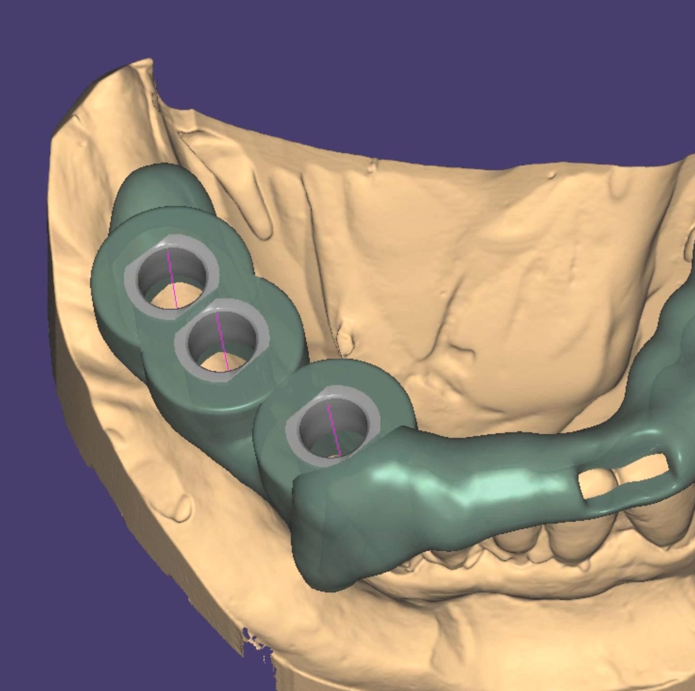 Surgical Guides CAD design – real design case 10